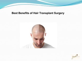 Best Benefits of Hair Transplant Surgery