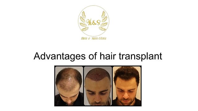 Advantages of hair transplant