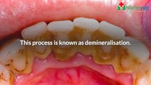 How are Dental Caries Formed? What Causes Dental Caries and Tooth Decay