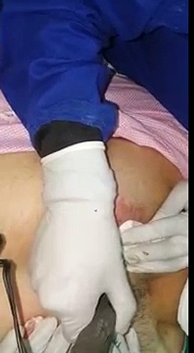 Check out Excelent Hair Transplant Surgery Results | FUE Hair Transplant in India