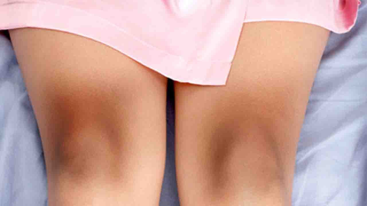 Black Knees: Home Remedies to get rid of | घुटनों का कालापन ऐसे करें दूर | Boldsky