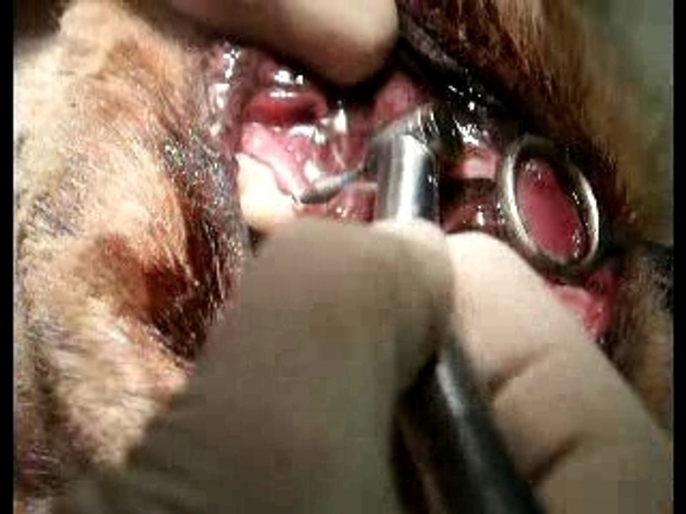 Gingivoplastie