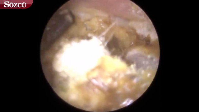 Sağır olduğunu düşünen kadının kulağının içinden çıkanlar şok etti