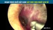 Đoạn video bắt gián gây khó chịu nhất Internet: Bác sĩ vô tình lùa gián chạy ngược vào tai bệnh nhân