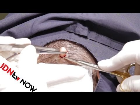 Siapa yang Sangka Sih Kalau Video Pencet Jerawat Ternyata Banyak yang Suka? | IDNtv NOW