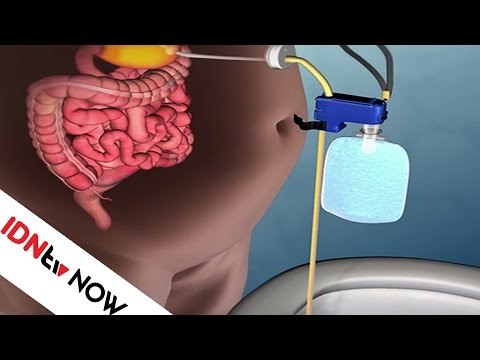 Alat Ini Dapat Mengeluarkan Makananmu Langsung Dari Perut ! | IDNtv NOW