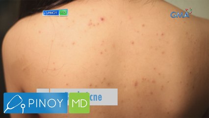 Pinoy MD: Solusyon sa back acne, alamin!
