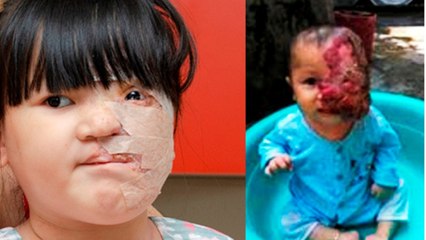 Operación milagro! Cirujanos del Gregorio Marañón reconstruyen cara de niña con un tumor gigante