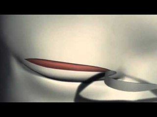 How double eyelid surgery works