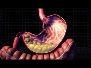 Cotton ball diet fad has dire health consequences