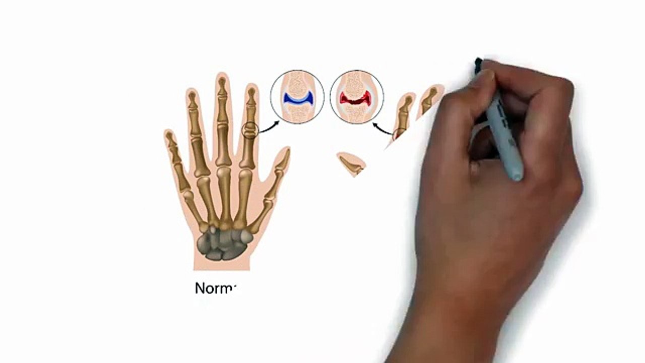 Rheumatoid Arthritis - How to Treat Arthritis Naturally - Home Remedies for Rheumatoid Arthritis