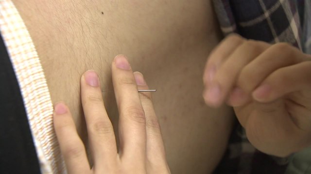 '침 치료' 갱년기 우울증 완화 효과, 과학적 입증 / YTN