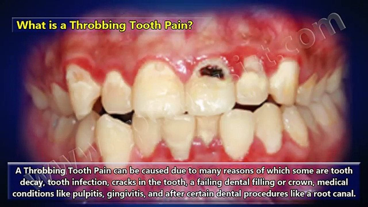 Causes & Treatment of Throbbing Tooth Pain