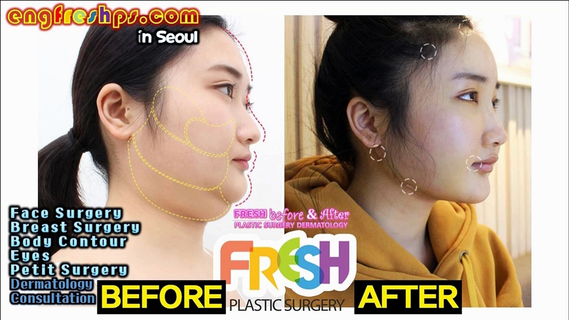 south Korea plastic surgery