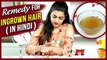 Ingrown Hair Removal At Home | Remedy For Ingrown Hair In Hindi | DIY | Ingrown Hair Treatment