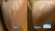 [Morning Show] Tips for removing dead skin from cracked heels! 갈라진 뒤꿈치 깨끗하게 각질제거하는 비법![생방송 오늘 아침] 20180531