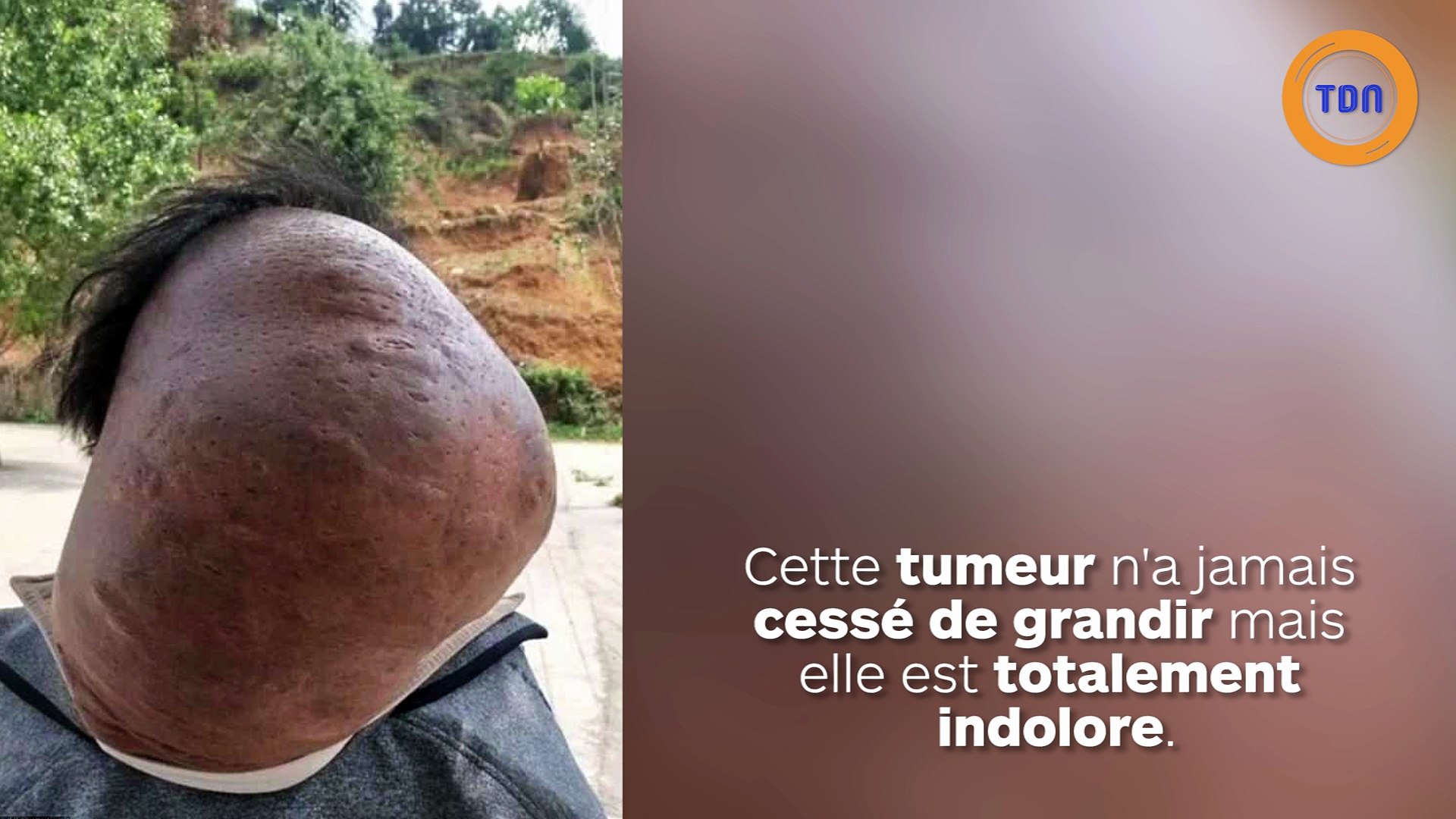 Cet Homme A Une Enorme Bosse Sur La Nuque Video Dailymotion