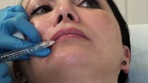 Lip Filler Treatment Melbourne - Nitai Medical & Cosmetic Centre
