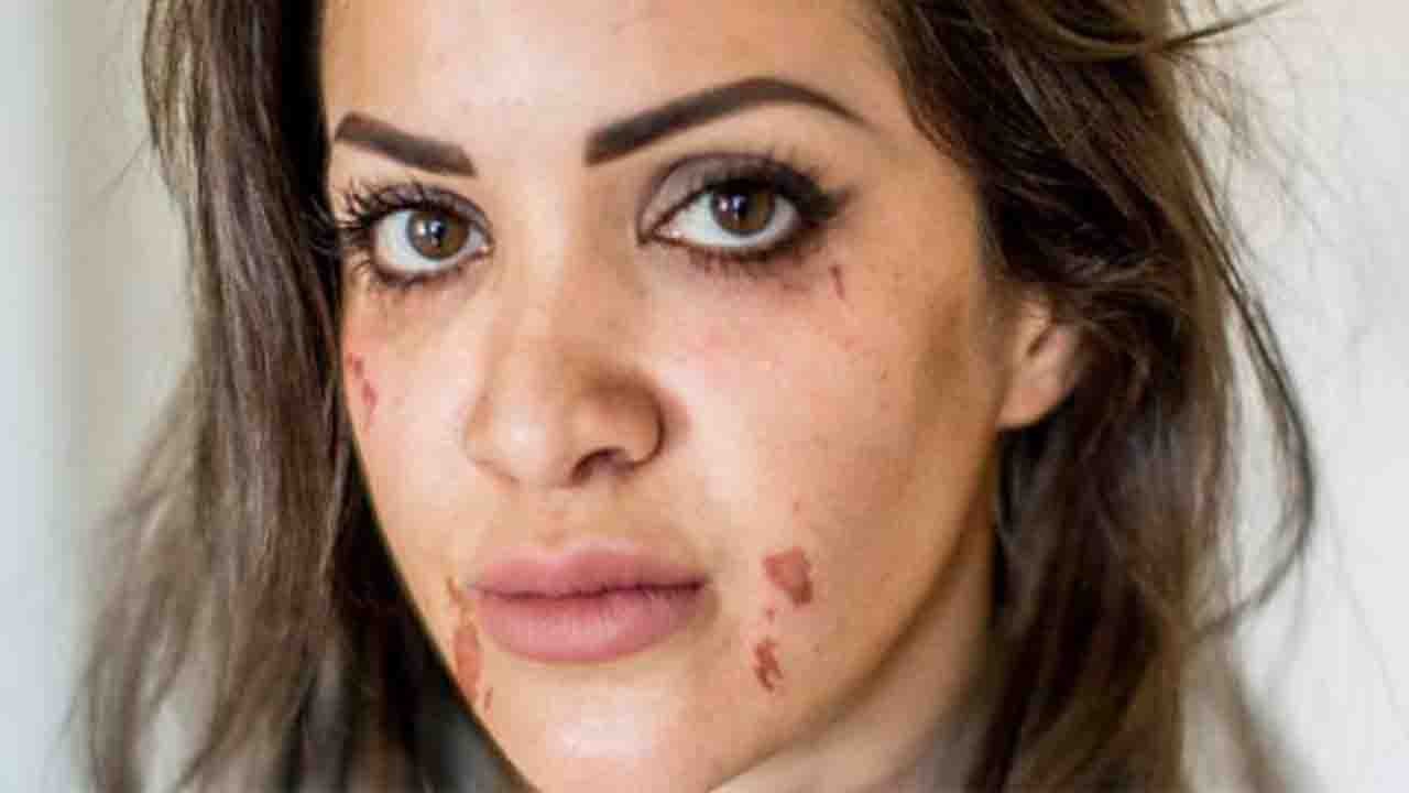 Burn Mark on face: Home Remedies | चेहरे पर जले के दाग दूर करेंगे ये घरेलू उपचार | Boldsky