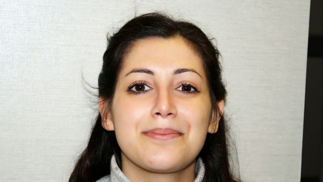 Op Dr Mustafa Ali Yanık burun şikayet ve çözümleri ve hasta sonuçları