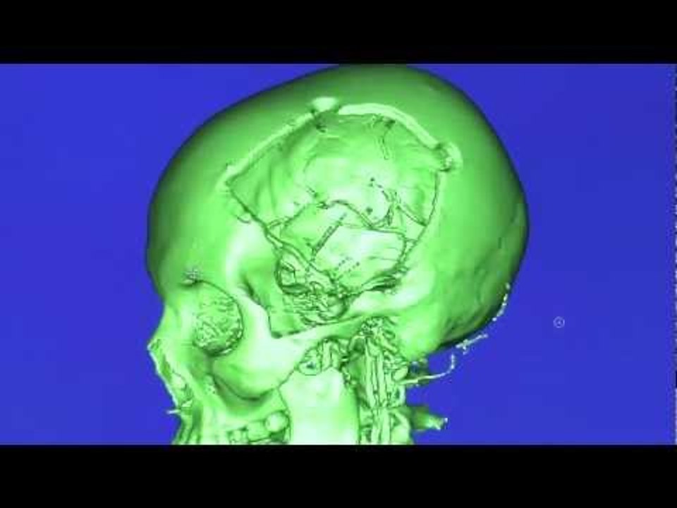 Surgery facing Taliban shooting schoolgirl Malala Yousafzai