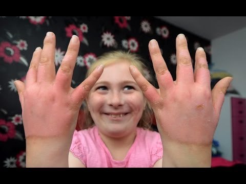 Girl Left With Third Degree Burns After Touching Toxic Plant