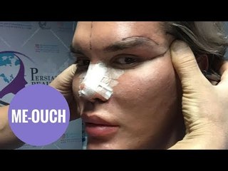 Human Ken Doll' takes selfie video during cat eye operation