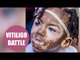 Girl developed vitiligo all over her body - triggered by a battle with meningitis