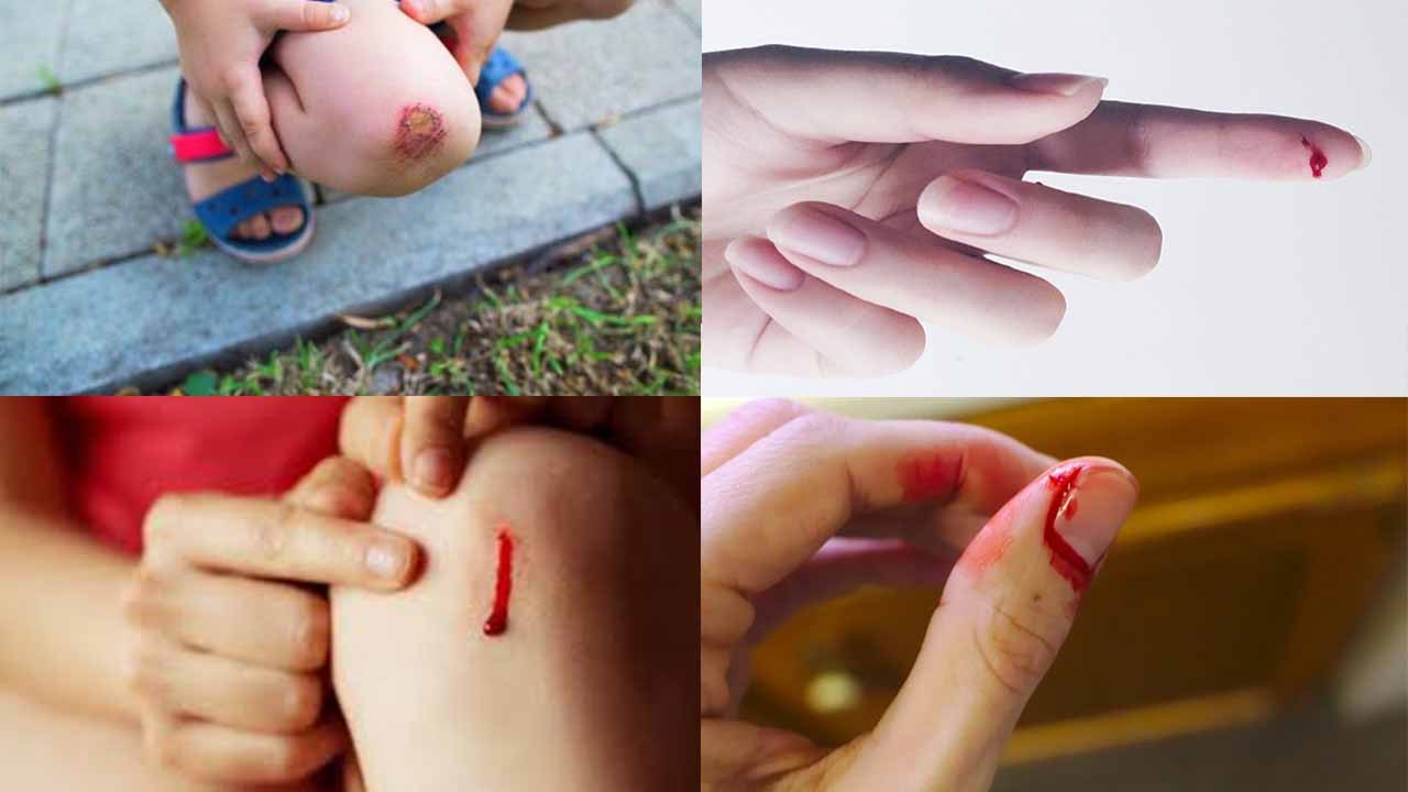 Acupressure: चोट का खून न रुक रहा हो तो दबायें ये Acupressure Point |Injury | Boldsky