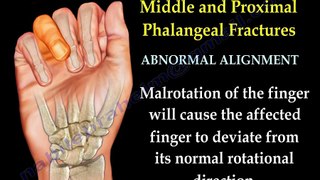 Finger and metacarpal Frures - Everything You Need To Know - Dr. Nabil Ebraheim