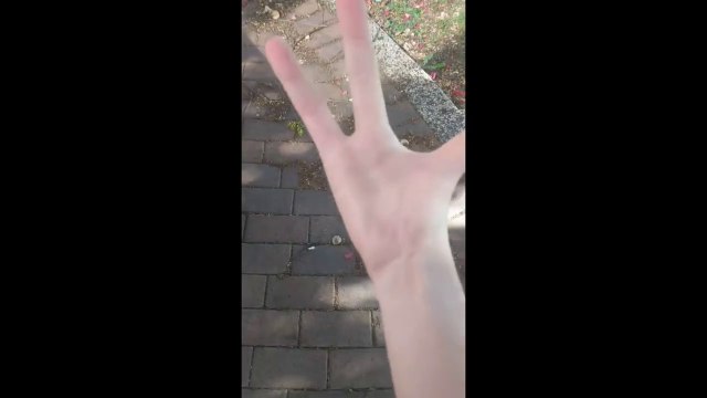 Cette fille est née avec une main à trois doigts