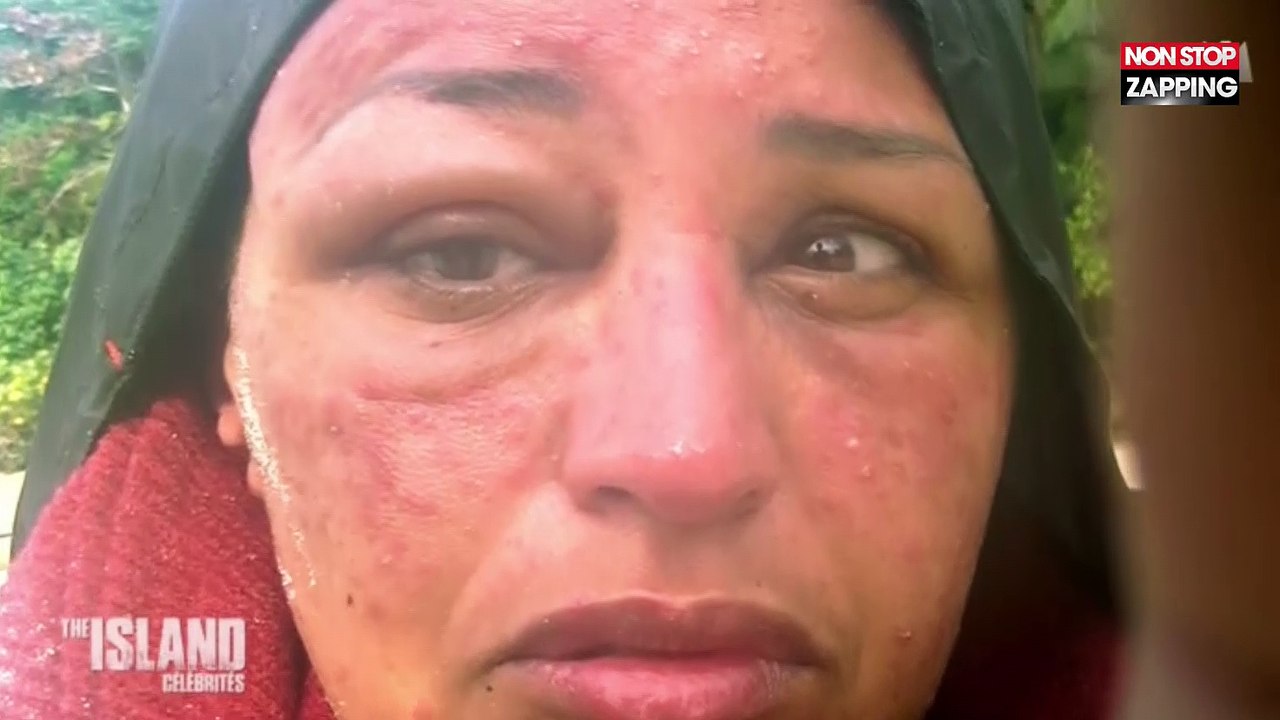The Island Célébrités : Lââm défigurée par les piqûres, elle quitte l'aventure (Vidéo)