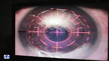 Kelly's Lasik Review of South Texas Eye Institute