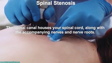 What is Spinal Stenosis?