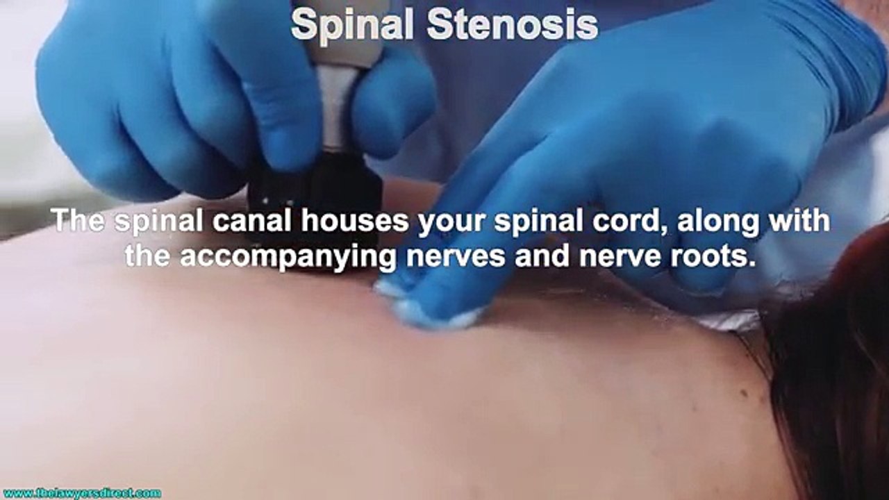 What is Spinal Stenosis?