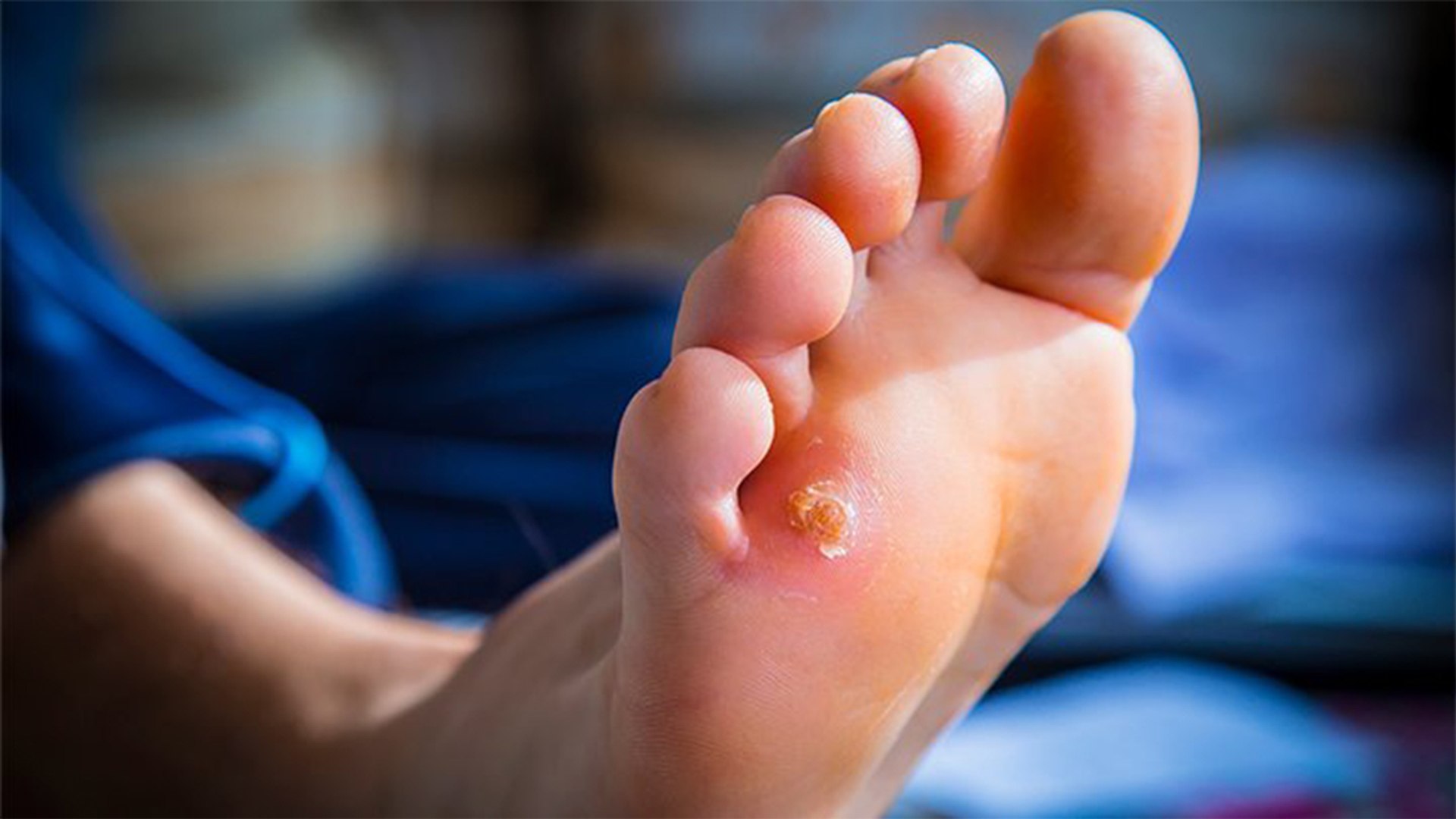 Foot Blisters - Shoe bite: Effective Remedies, पैर के छाले दूर करेंगे ये  घरेलु नुस्खे | Boldsky - video Dailymotion