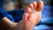 Foot Blisters - Shoe bite: Effective Remedies, पैर के छाले दूर करेंगे ये घरेलु नुस्खे | Boldsky