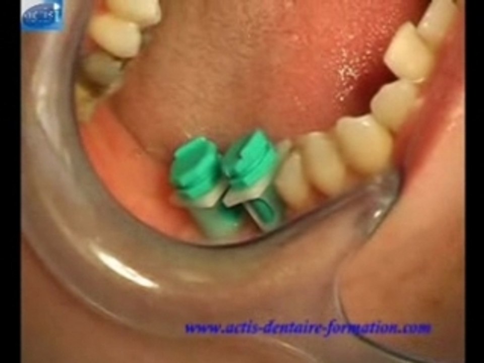 Empreinte implant