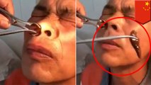 Doctor pulls out live 4-inch leech from Chinese man’s nose - TomoNews