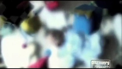 Shwachman - Diamond Syndrome (SDS) - Documentary