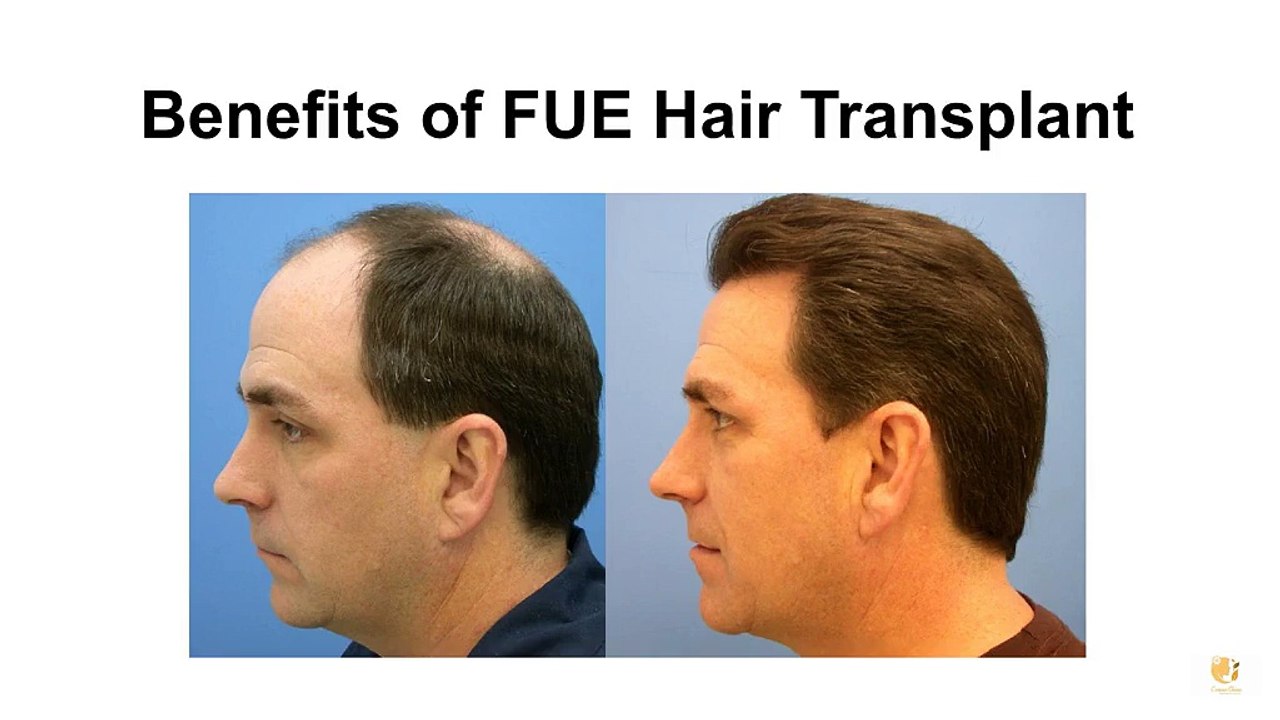 Benefits of FUE Hair Transplant