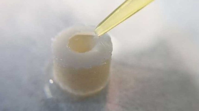 FUTURIS Arthrose : l'espoir des thérapies ciblées