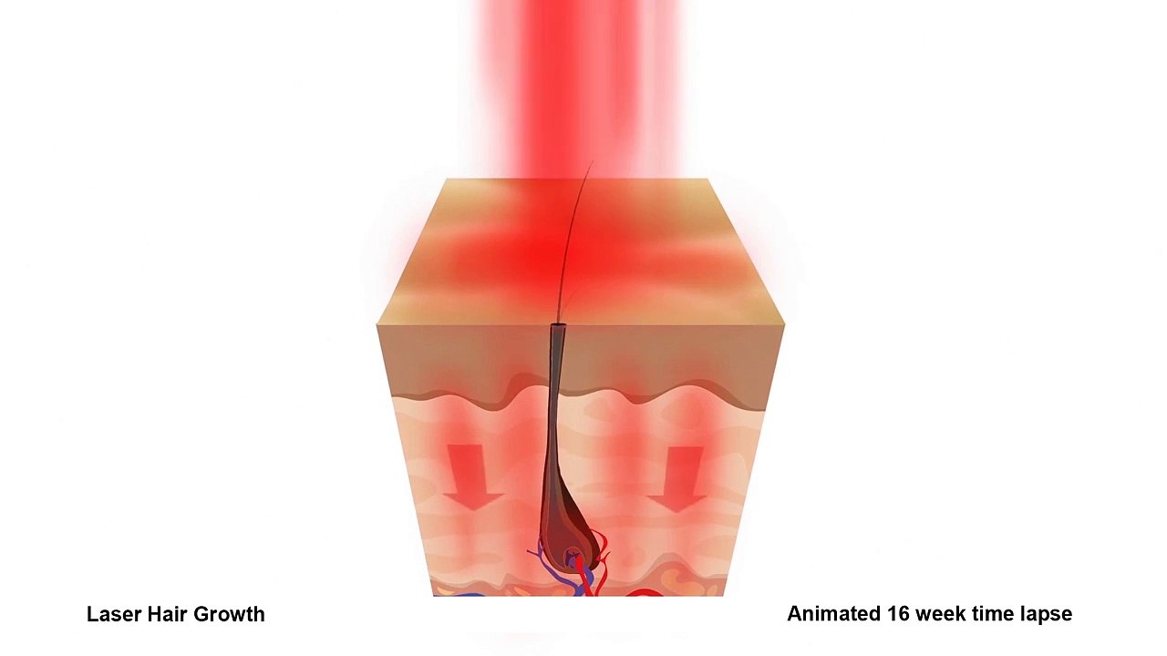 Laser Hair Growth 16 Week Animation - Hair Regrowth Australia