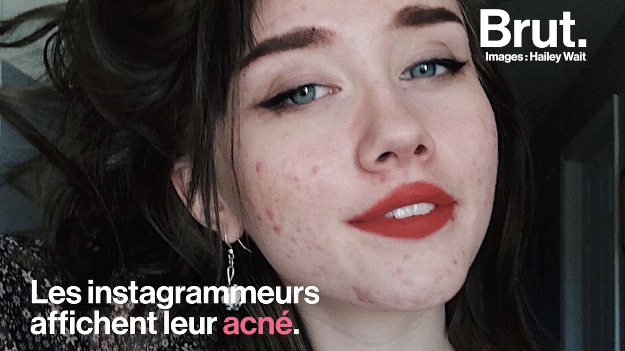 Voilà pourquoi ces ados assument leur acné sur...