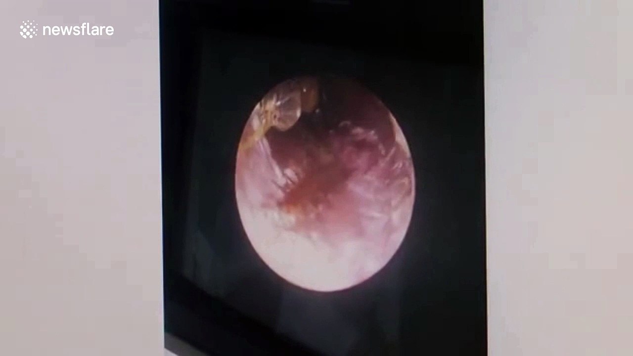Doctor pulls live cockroach from man's ear