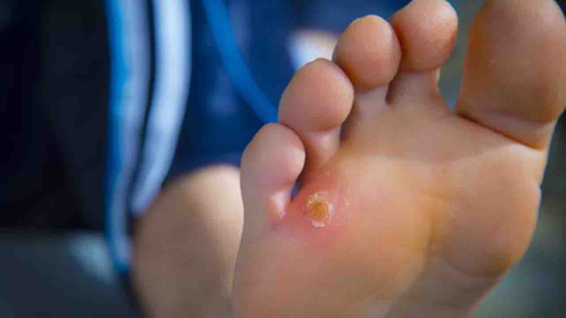 Foot Corn Home Remedies | Foot Corn को हमेशा के लिए ठीक कर देंगे ये घरेलू उपाय | Boldsky