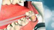 Protect Your Damaged Teeth with Dental Implant