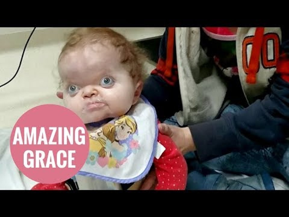 Toddler with rare condition defies doctors to sit up for the first time