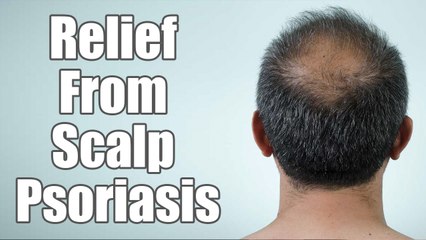 How To Grow Hair On The Bald Patches On Head? | Boldsky