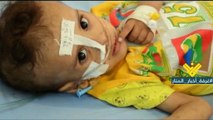 مئة الف طفل يمني مهددون بالاصابة بسوء التغذية ومرض الكوليرا